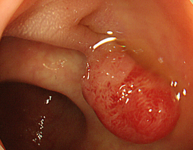 大腸内視鏡検査（大腸ファイバー）